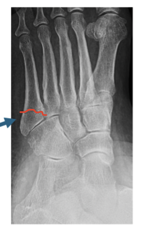 <p>Treatment plan for Zone II 5th metatarsal base fracture</p>