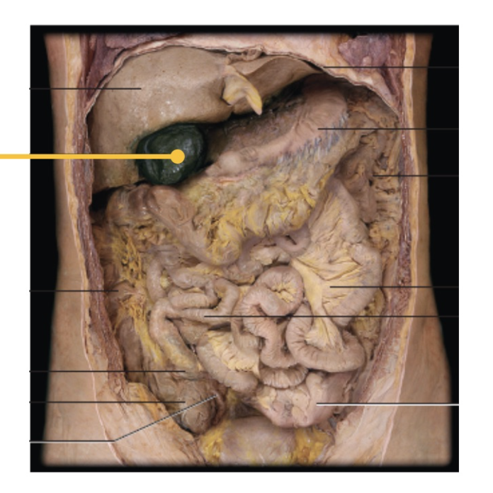<p><span>An uncomplicated surgical removal of the tagged structure (yellow) would typically result in which of the following?</span></p>