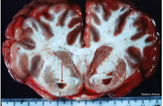 <p>regionalized necrosis</p>