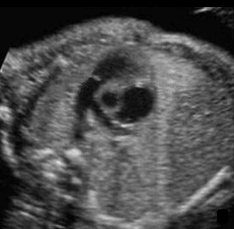 <p>where is the descending AO</p><ul><li><p>under ductus arteriosus</p></li></ul><p></p>