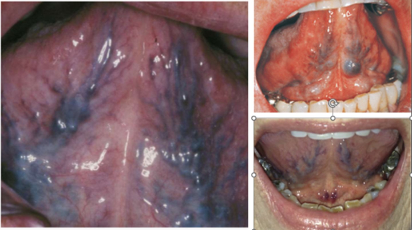 <p>May swell during eating</p><p>- Lingual varicosities DO NOT swell during the eating process. </p><p>- Red to purple enlarged vessels are seen with lingual varicosities. </p><p>- Lingual varicosities may be associated with varicosities in the legs. </p><p>- Lingual varicosities are considered an age-related condition, often seen in individuals over the age of 60.</p>