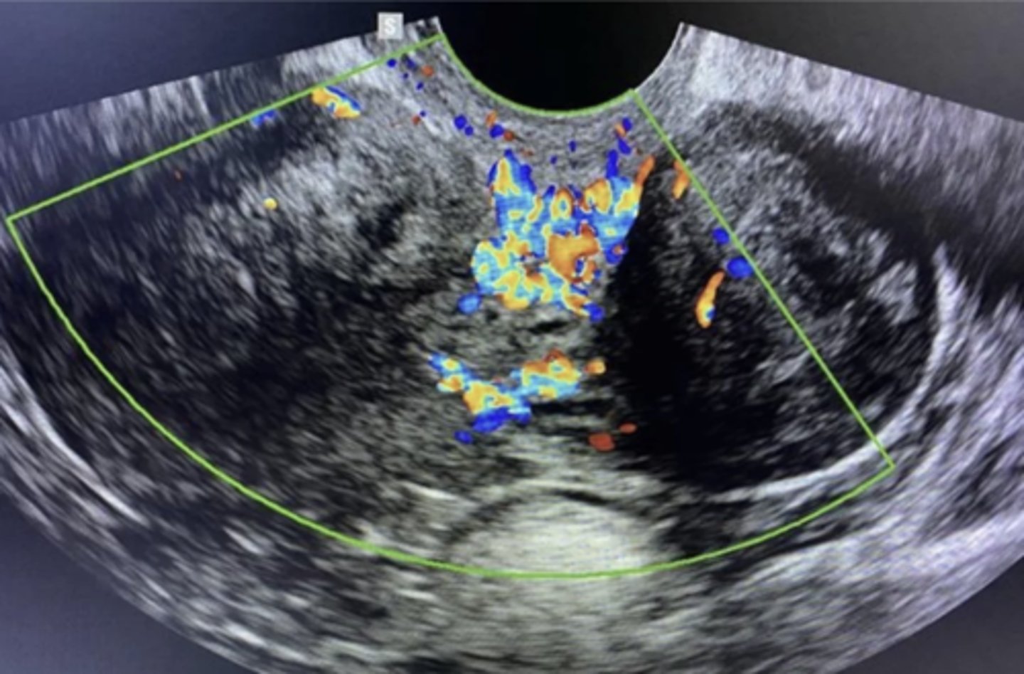 <p>Pedunculated fibroid</p>