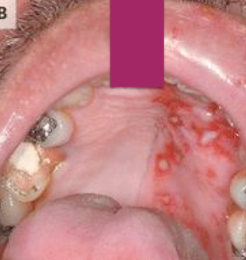 <p>Which age group does Varicella-Zoster Shingles (VZV/HHV3) commonly occur in? </p>