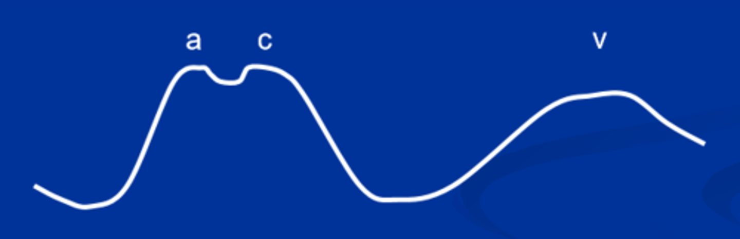 <p>a - rise in pressure. atrial systole.</p><p>c - isovolumetric ventricular contraction causing bulging of the AV tricuspid valve.</p><p>v - rise is pressure. atrium fills during ventricular systole.</p>