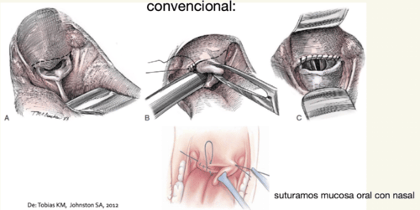 <p>marcamos la parte que queremos quitar, lo tiro rostralmente y cortamos con bisturí eléctrico, láser CO2, o convencional.</p><p>para convencional, cerramos mucosa oral con mucosa nasal con sutura continua.</p>