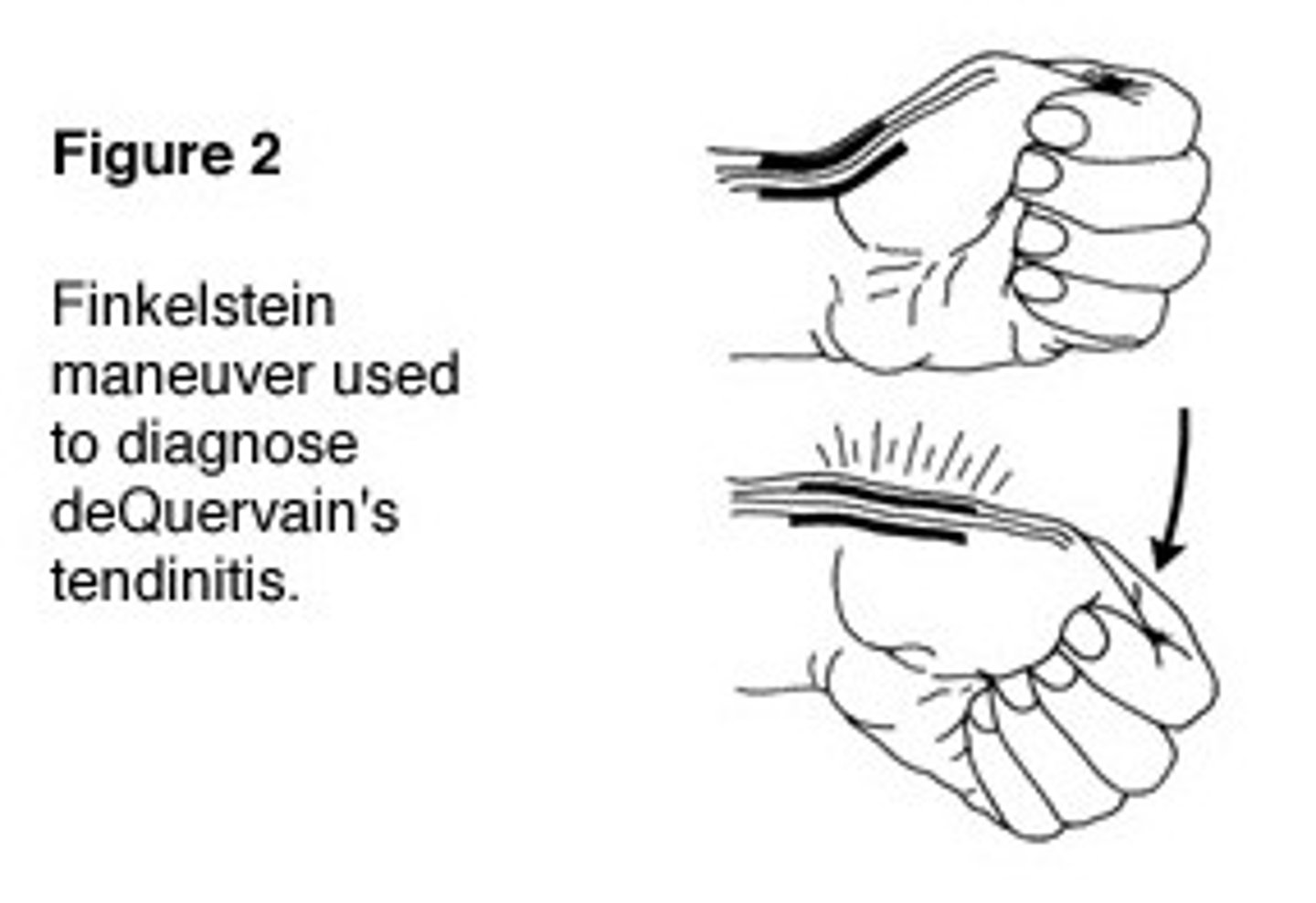 <p>assessment for deformity or atrophy. Palpation for tenderness as well as testing of upper extremity strength, sensation, reflexes and ROM should be assessed. Phalen's and Tinnels tests should be done to rule out CTS.</p><p>The confirmatory test for DQS is the Finkelstein test. The Finkelstein test is performed by having the patient place their thumb against their hand, making a fist with the fingers closed around the thumb. The patient then is asked to bend the wrist forward toward the little finger. The test is positive if pain is reproduced over the tendon on the thumb side of the wrist.</p>