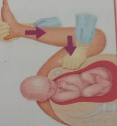 <ul><li><p>commonly the first maneuver performed along with suprapubic pressure</p></li><li><p><strong>will straighten the maternal sacrum on the lumbar spine</strong></p></li></ul><p></p>