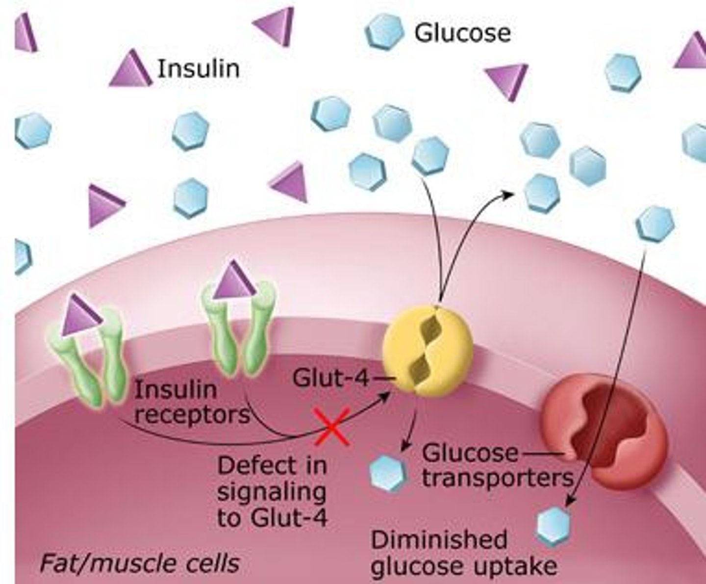 <p>Diabetes mellitus is caused by a disruption of insulin/GLUT 4 mechanism. In type I diabetes, insulin is absent and cannot stimulate the insulin receptor (therefore, no additional GLUT 4 added to PM to reduce [blood glucose]).</p><p>In Type II, the receptor becomes insensitive to insulin and no GLUT 4 are added to PM.</p><p>Both result in high levels of blood glucose.</p><p>Inflammation of beta cells, or "insulitis," is a key feature of type 1 diabetes where the immune system mistakenly attacks and destroys these insulin-producing cells, leading to insulin deficiency.</p><p>A major defect in insulin resistance is the inability of insulin to effectively signal the translocation of GLUT4 from intracellular storage vesicles to the cell surface.</p>