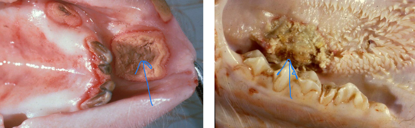 <ul><li><p>Ulcers/erosions</p></li><li><p>Pseudomembranes</p><ul><li><p><span><span>a false membrane-like layer of inflammatory material, typically consisting of mucus, dead cells, and inflammatory cells, that forms on a mucous membrane or skin surface</span></span></p></li></ul></li></ul><p></p>