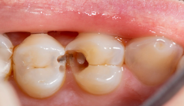 <p><strong>S/S, Diagnosis, Treatment, and Prevention of Cavities </strong></p><p>-Most asymptomatic, toothache, hot/cold __________, ______ spot early on develops into a _____ spot or hole. </p><p>-Diagnosed by the dentist</p><p>-First line treatment is _______ and root canals/crowns in severe decay</p><p>-Prevention: daily flossing, brushing twice daily, regular dental exams </p>