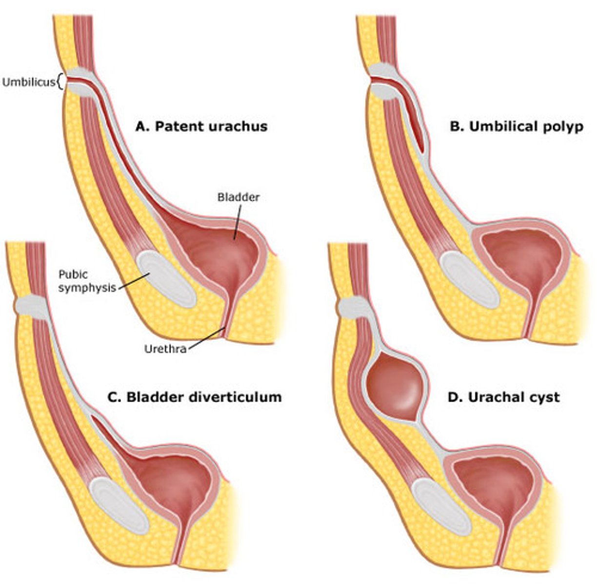 <p>- Urachal cysts present on the apex of the bladder</p><p>- Urachal diverticulum (Also, very rarely can get drainage of the bladder into the bladder itself causing a uroperitoneum)</p>