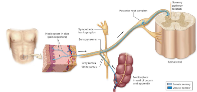 <p>Inaccurate localization of sensory signals, where signals from viscera are perceived as originating from skin or muscle.</p>