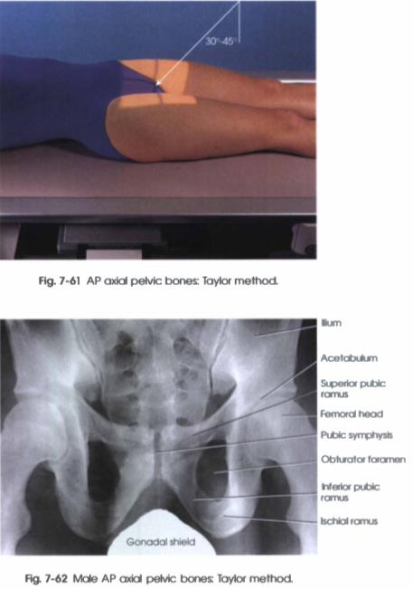 <p><strong>PP: </strong>Supine; ASISs equidistant from table; knee flexed slightly</p><p><strong>RP: </strong>2 in. distal to superior border of pubic symphysis</p><p><strong>CR: </strong>20-35o cephalad (males); 30-45o (females)</p><p><strong>SS: </strong>Pelvic outlet<br>• <strong>Superior &amp; inferior rami without foreshortening</strong></p><p></p>