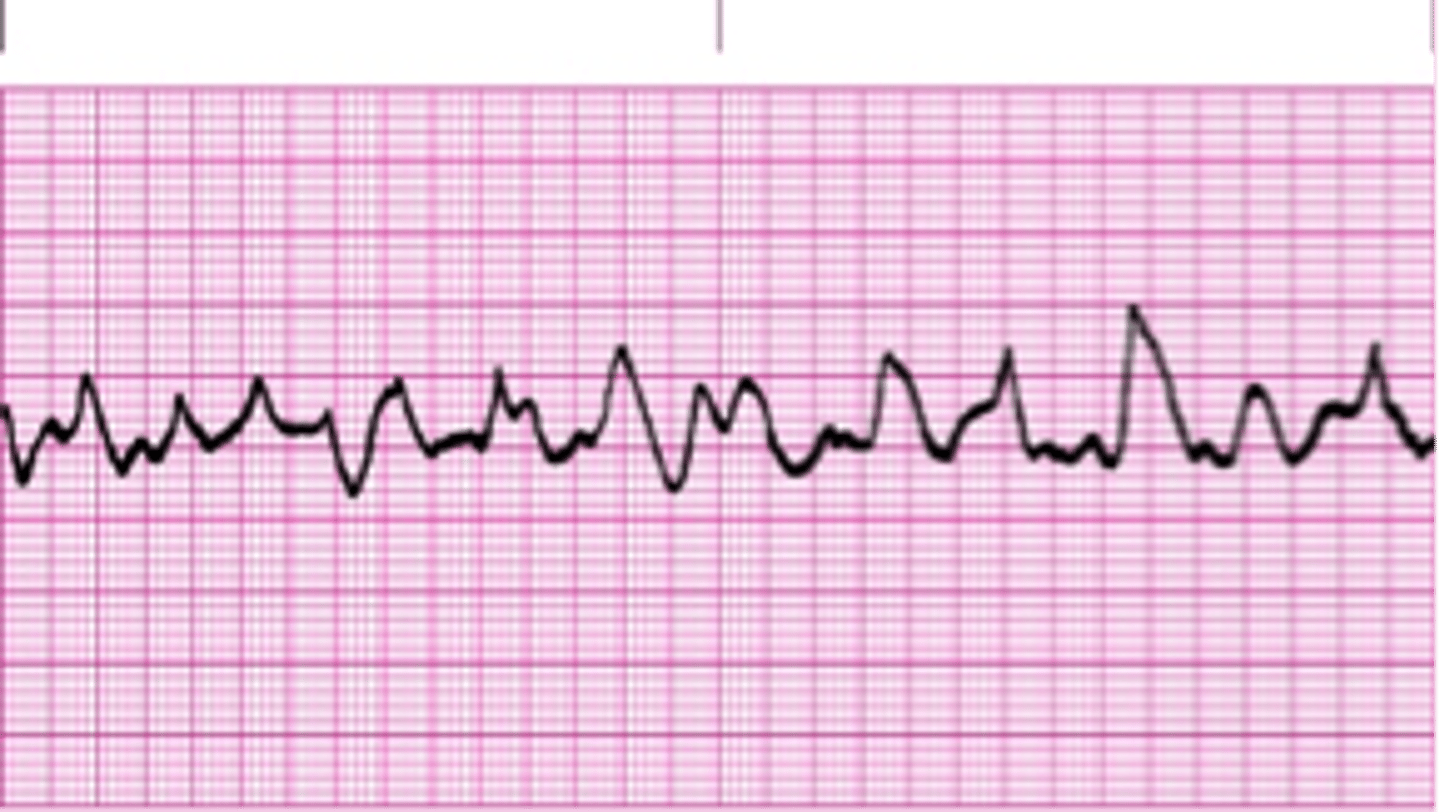 <p>-p waves absent </p><p>-QRS absent </p><p>-P:QRS n/a</p><p>-spasmodic (coarse) or gentle undulation (fine) of ECG tracing </p><p>-seen almost solely in dying hearts </p><p>-most frequently encountered arrhythmia in sudden death </p><p>-often preceded by VT </p><p>-need immediate CPR and defibrillation </p>