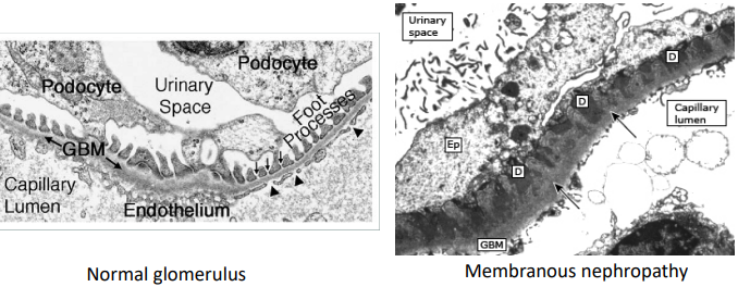 <p>Compare the podocyte processes in these electron microscopy images:</p><ul><li><p>Dark patches (D) scattered within a thickened glomerular basement membrane (GBM)</p></li></ul><p>primary glomer?</p>
