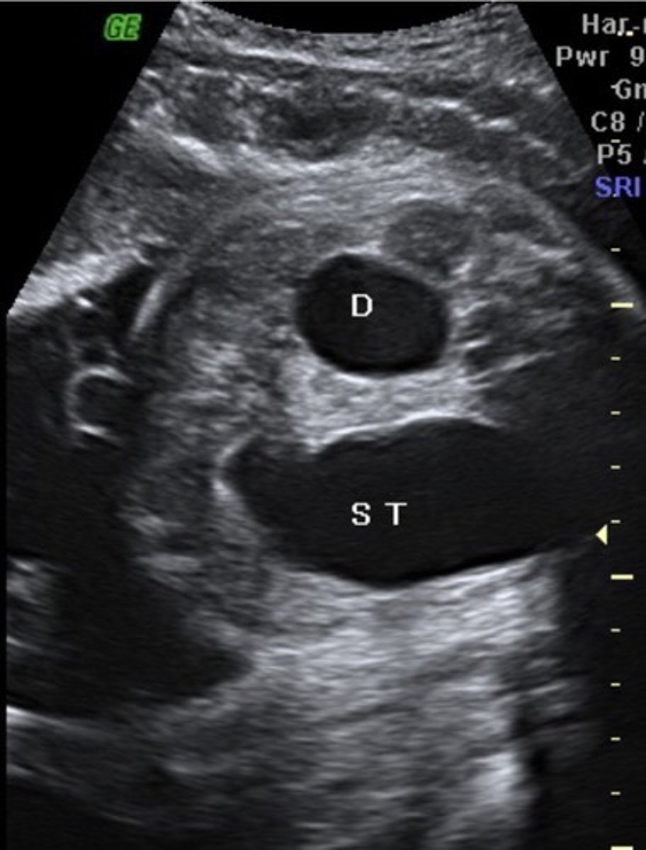 <p>Fluid reaches duodenum, but cannot move past it</p><p>Double Bubble Sign</p><p>Enlarged stomach &amp; prox. duodenum</p>