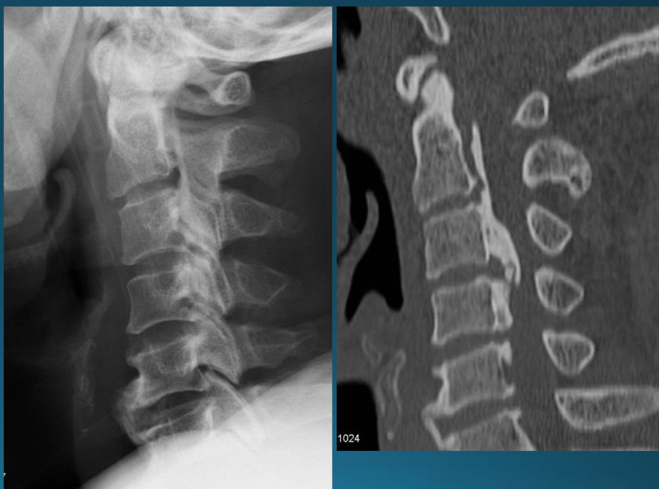 <p>what is the finding in this radiograph? AKA?</p>