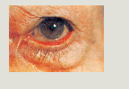 <p>ectropion</p>