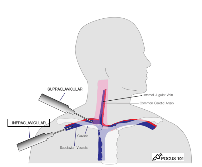 <p>b. 1–2 cm lateral to the insertion of the clavicle and first rib</p><p></p>