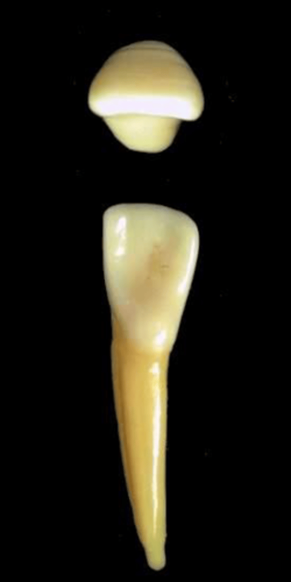 <p>what tooth is this &amp; why?</p>