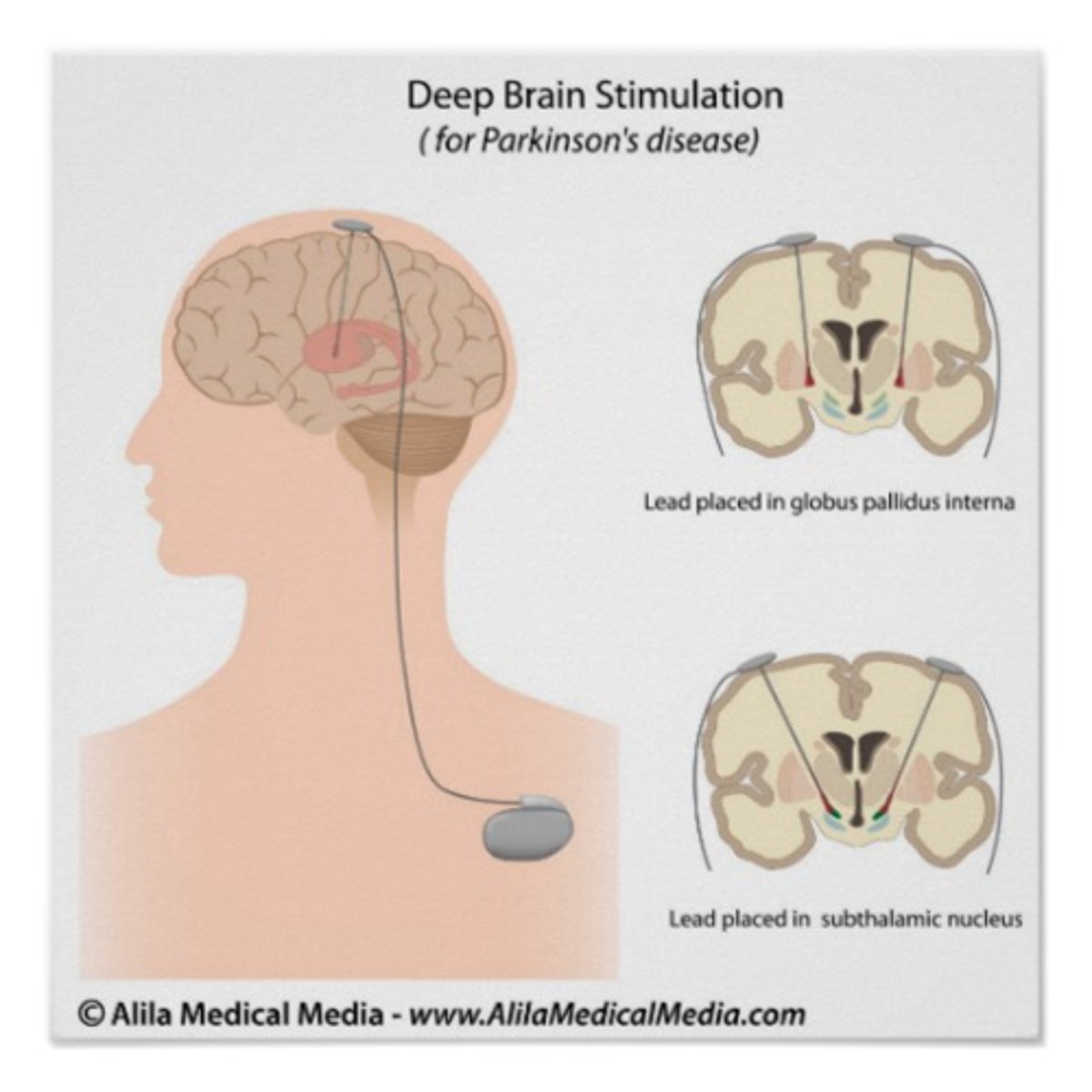 <p>used to treat severe depression; electrodes placed inside brain in basal ganglia<br>- very invasive so risk for infection but best results, usually immediate</p>