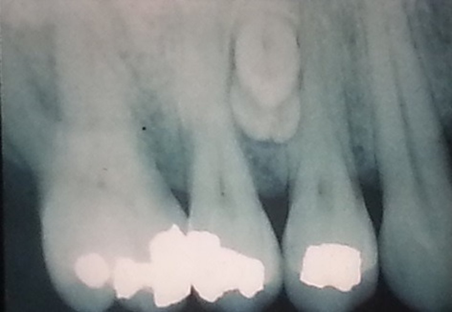 <p>anterior jaws</p><p>*most common = mesiodens</p>