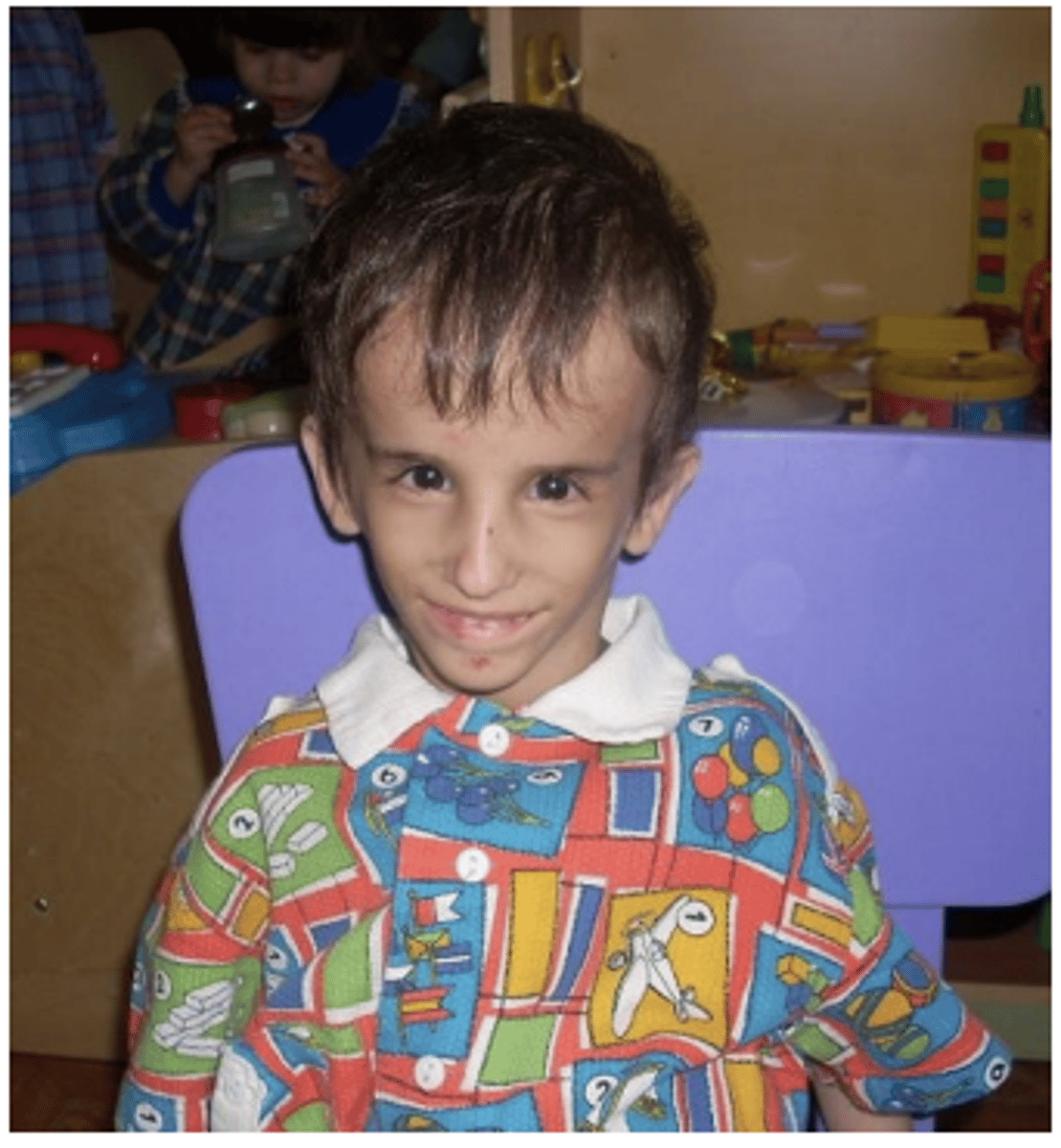 <p>What is a common facial shape seen in patients with Osteogenesis Imperfecta?</p>