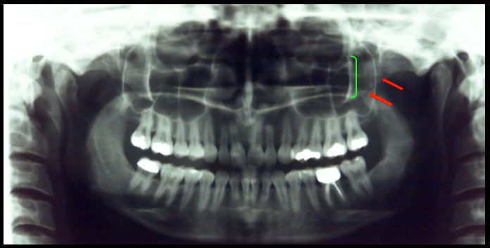 <ul><li><p><span>Appears as a J or U-shaped radiopacity located superior to the maxillary first molar region.</span></p></li><li><p><span>Appear as a diffuse radiopaque band that extends posteriorly from the zygomatic process of the maxilla.</span></p></li></ul><p></p>