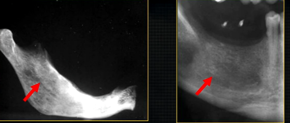 <p>radiolucent band around the posterior part of the body of the mandible </p>