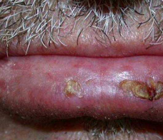 <p>premalignant lesion on lip due to UV light exposure </p>