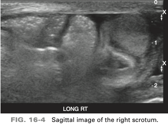 <p>an 85-year-old patient presents with intermittent scrotal swelling. He states the swelling “comes and goes”. On the basis of the clinical history, the sono finding is most suspicious for </p>