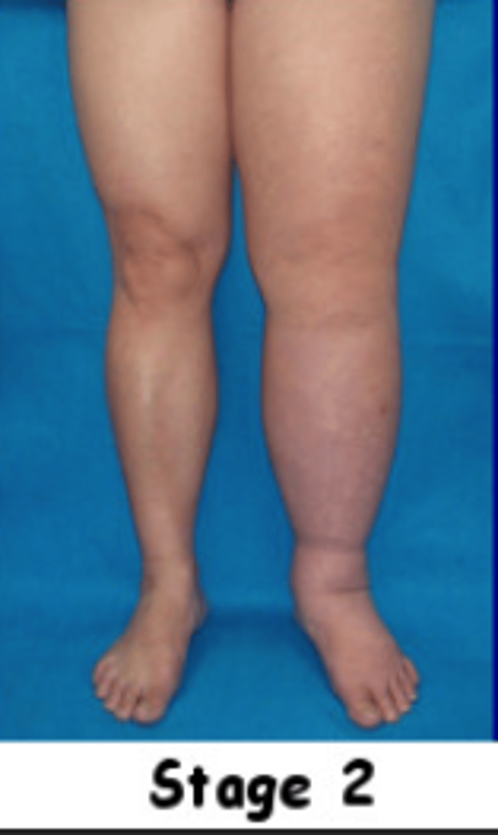 <p>-Irreversible</p><p>-May have pitting edema that progresses to hard/brawny edema</p><p>-Stemmer sign = (+) --> but may be (-) in early stage 2</p><p>-Tissue appears fibrosclerotic and proliferation of adipose tissue</p>