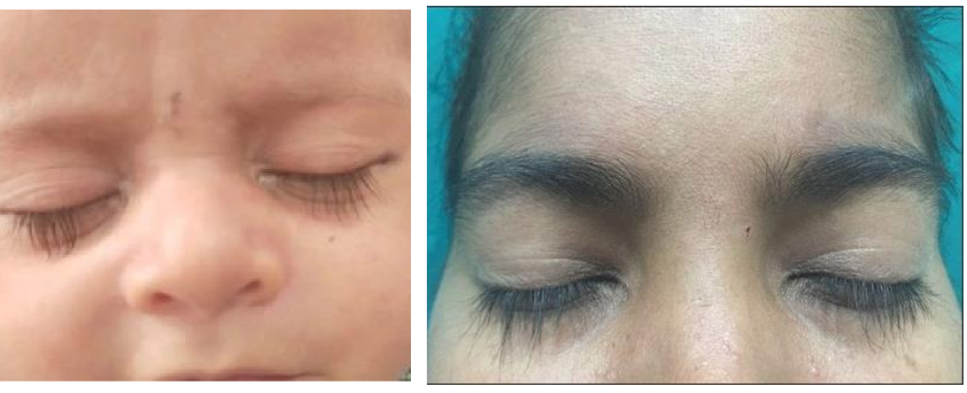 <p>What eyelash condition is this?</p>