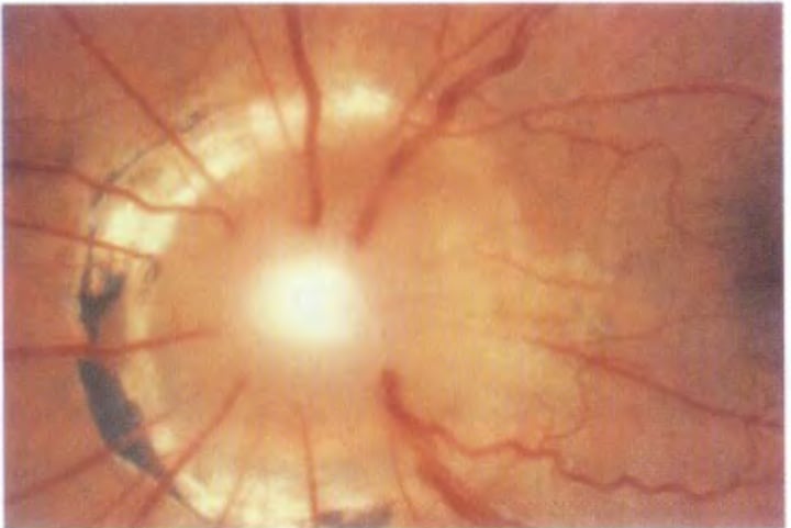 <p>Unilateral Female<br>Funnel-shaped optic nerve that looks slightly pushed in with peripapillary pigment changes<br>(+)APD and 35% association with serous RD<br>- need full CNS and endocrine eval</p>