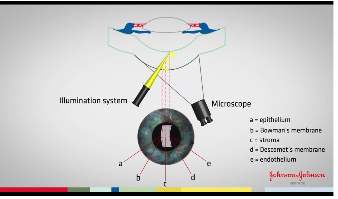 <p>Optical section corneal </p>