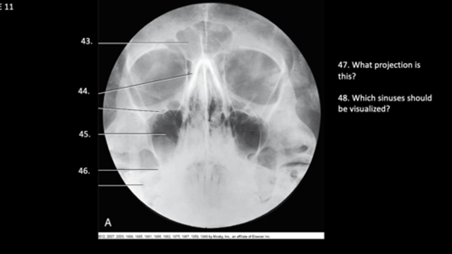 <p>What projection is this, and what sinuses should be visualized?</p>