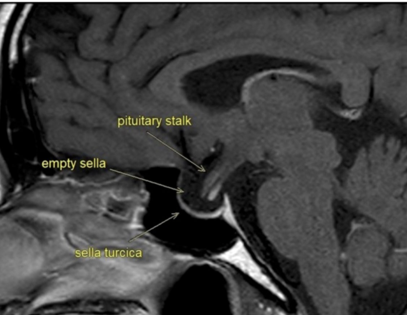 <p>Enlarged sella turcica that is not entirely filled with pituitary tissue because it is flattened or shrunken and patient tends to be asymptomatic</p>