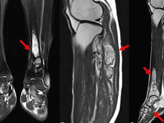 <p>What would be seen on a MRI for angiosarcomas?</p>