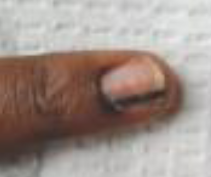 <p>linear streak formed as the nail grows out, caused by increased pigmentation in the nail matrix, thin &amp; uniform = nevus. Wide or irregular = concerning for subungal melanoma</p>