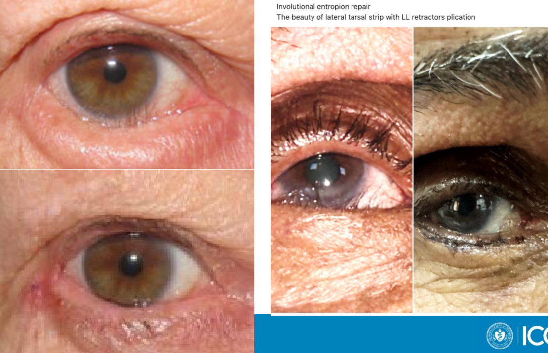 <p>What type of eyelid position is managed <em>permanently</em> by:</p><ul><li><p>Involutional: lid surgery</p></li><li><p>Cicatricial: mucous membrane or amniotic membrane graft</p></li><li><p>Spastic: antibiotics or immunosuppressives</p></li></ul><p></p>