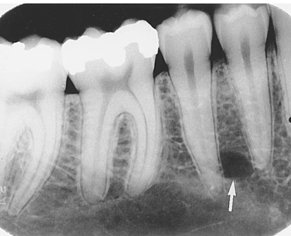 <p><span><span>·</span></span><span style="font-family: "Times New Roman"; line-height: normal; font-size: 7pt;"><span> </span></span><span><span>An opening or hole in bone located on the external surface of the mandible in the region of the mandibular premolars</span></span></p><p class="MsoListParagraphCxSpLast"><span><span>·</span></span><span style="font-family: "Times New Roman"; line-height: normal; font-size: 7pt;"><span> </span></span><span><span>A small ovoid or round radiolucent area located in the apical region of the mandibular premolars</span></span></p>