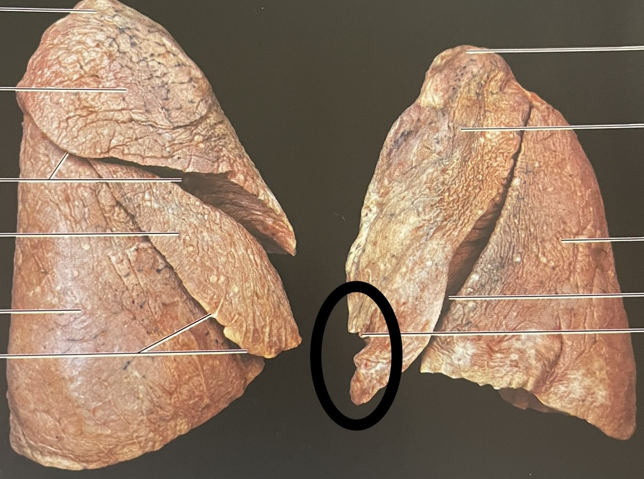 heart impression on left superior lobe
