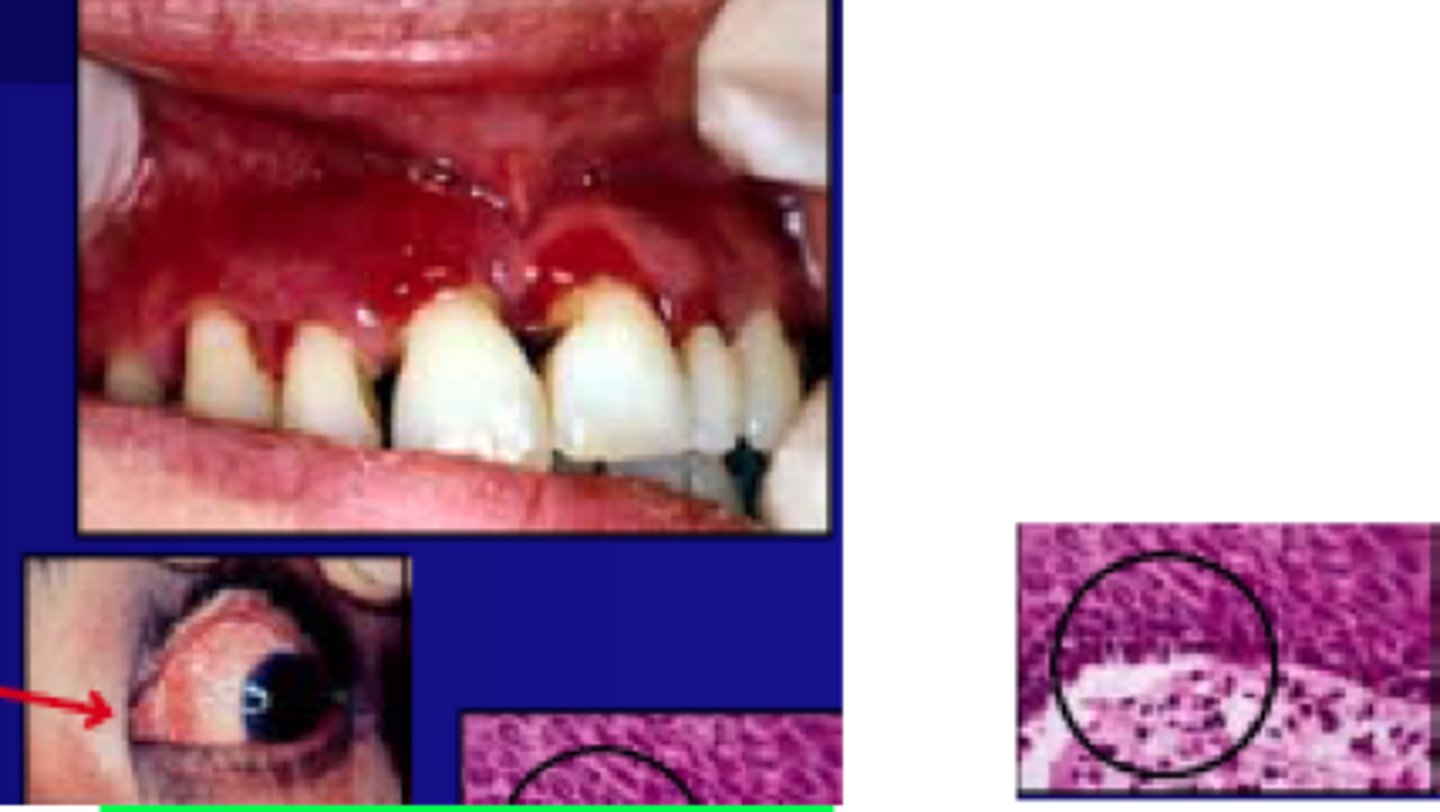 <p>AKA cicatricial pemphigoid </p><p>• multiple ulcers/erosions </p><p>• positive Nikolsky sign</p><p>• eye scarring; no skin lesions</p><p>• autoimmune disease: HEMIDESMOSOMES</p><p>• common location: gingiva (mucosa)</p><p>• population: older females over 65</p>