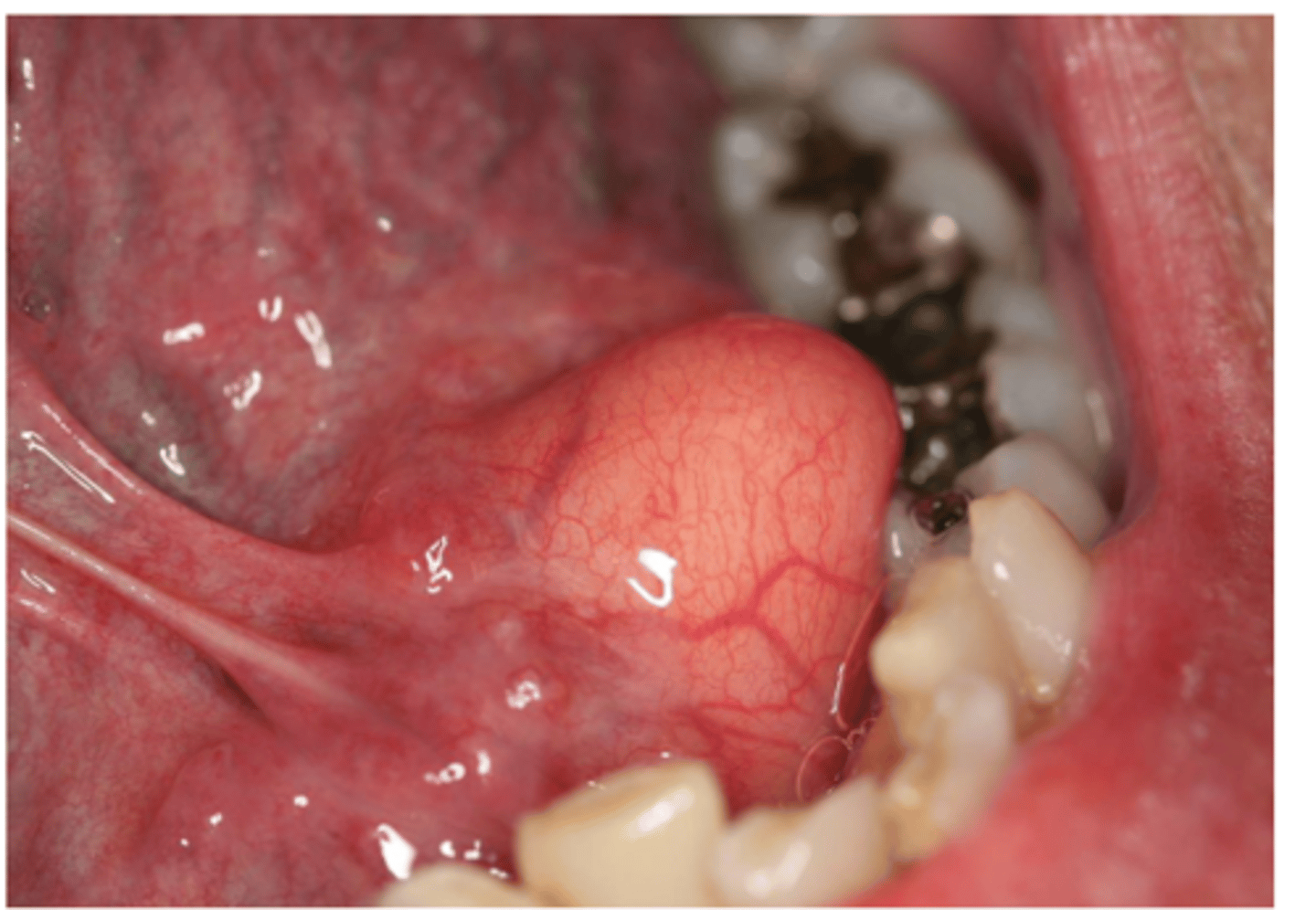<p>• Benign tumor of fat</p><p>• 4% of mesenchymal tumors of</p><p>oral cavity</p>