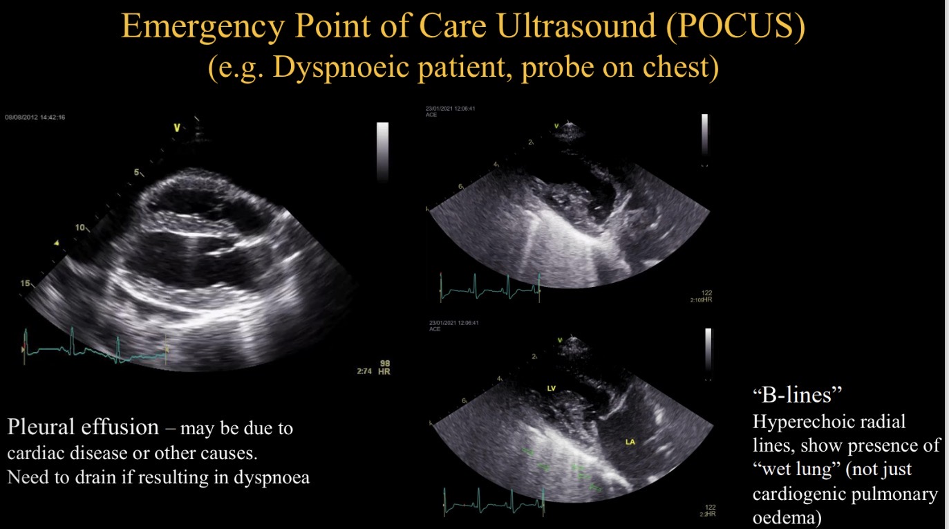 <p>Identify pleural effusion + drain </p><p>Identify hyperechoic lines (B lines) </p>
