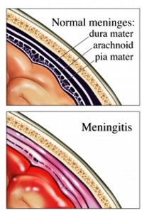 <p><strong><em>bacterial meningitis&nbsp;</em></strong></p><p></p>