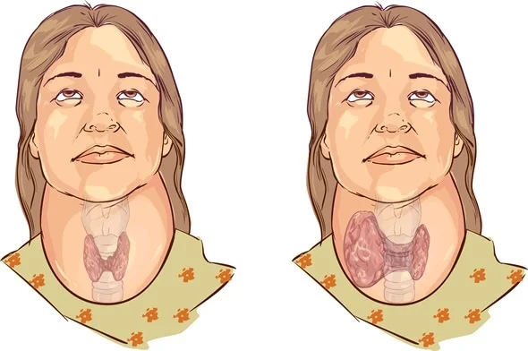 <p>Hypertrophy (enlargement) of the thyroid gland → making it swollen</p>