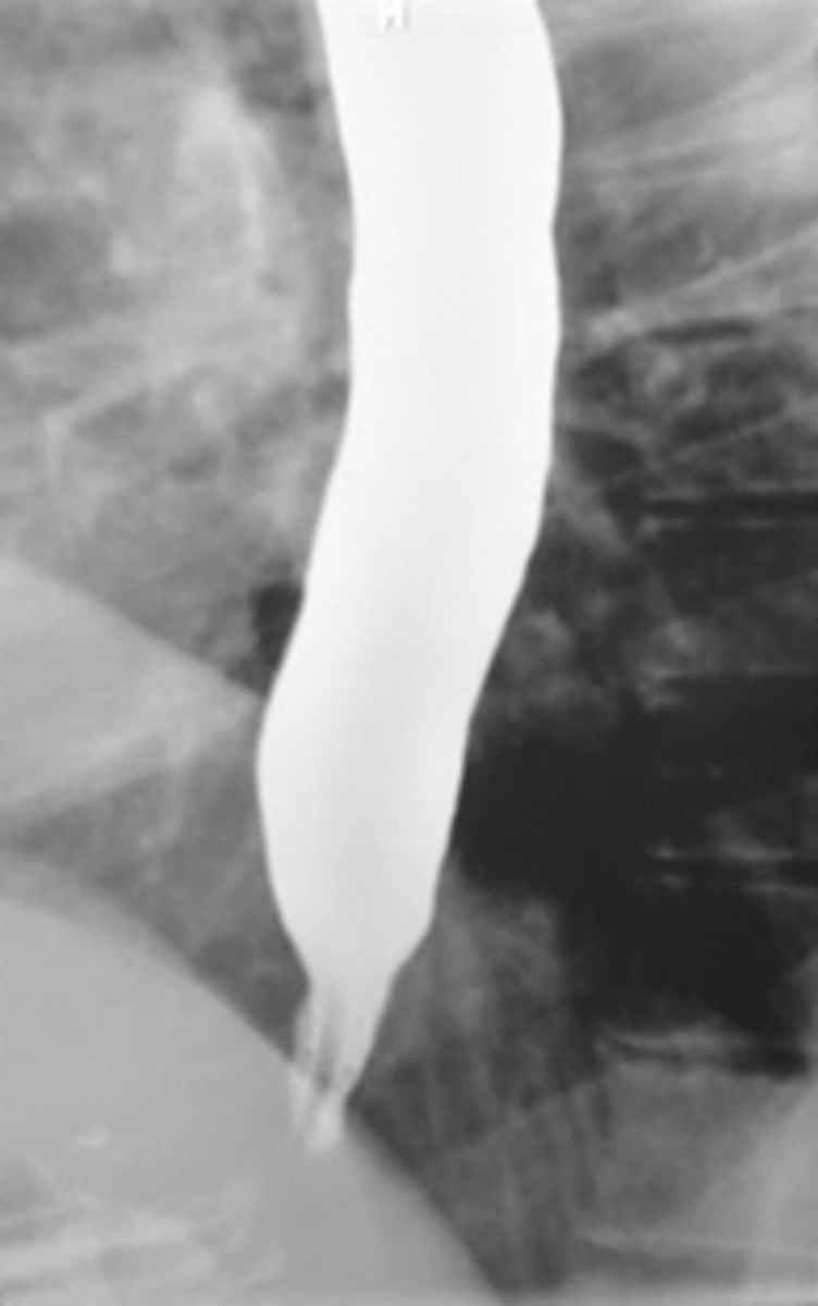 <p>Achalasia</p>