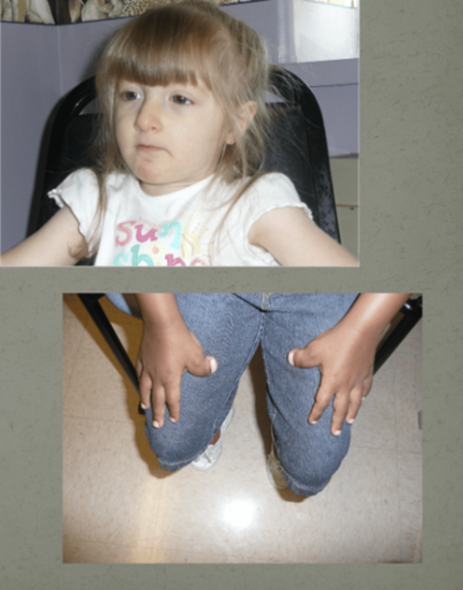 <p>Rubinstein-Taybi Syndrome</p>