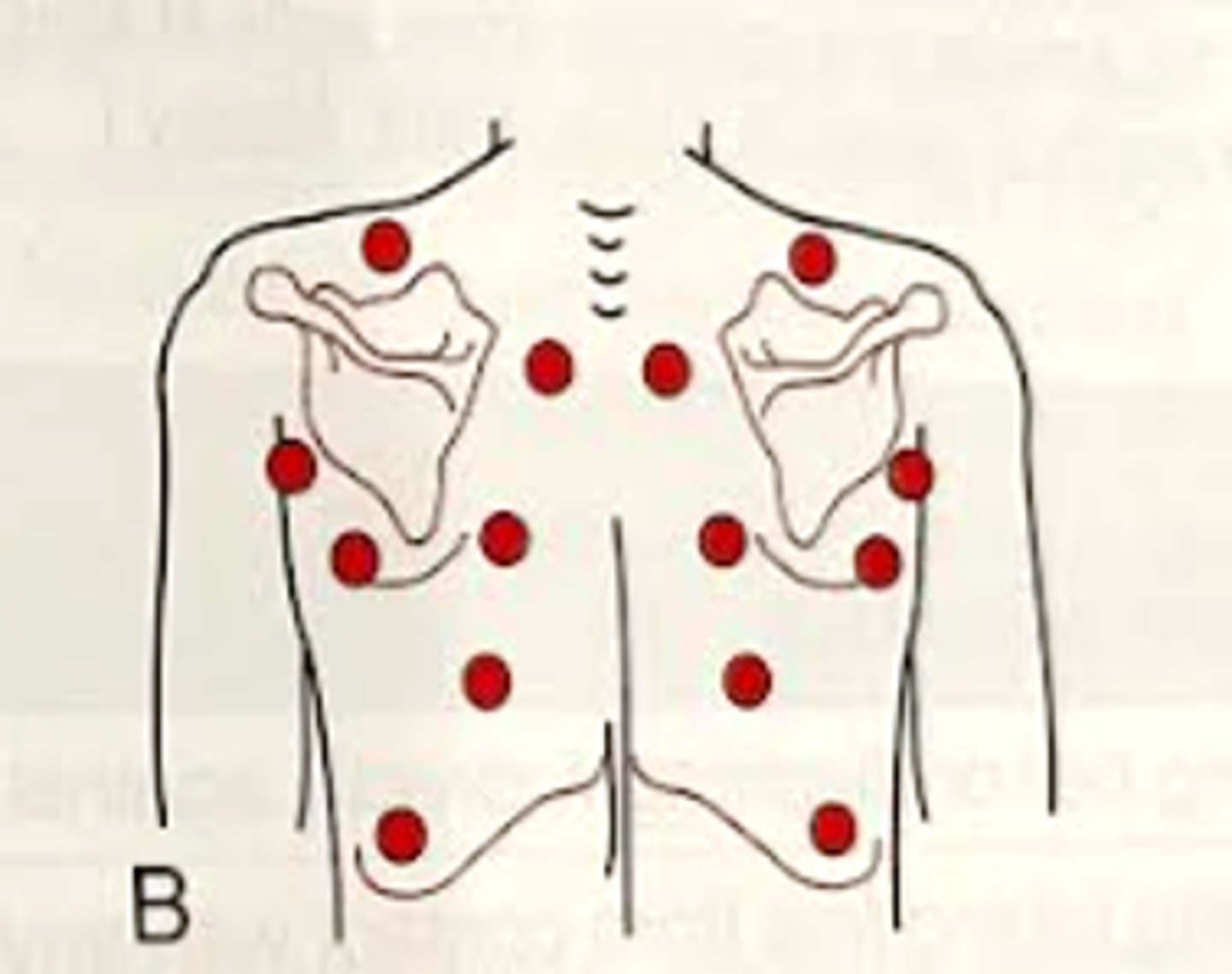 <p>Start above the scapula at the apex of the lungs<br>-Intercostal spaces between C7 - T3 between spine and scapula (upper lobes of right and left lungs)<br>-Intercostal spaces between T3 - T10 between spine and scapula (lower lobes of right and left lungs)<br>-Midaxillary when below scapula (lower lobes of right and left lungs)</p>